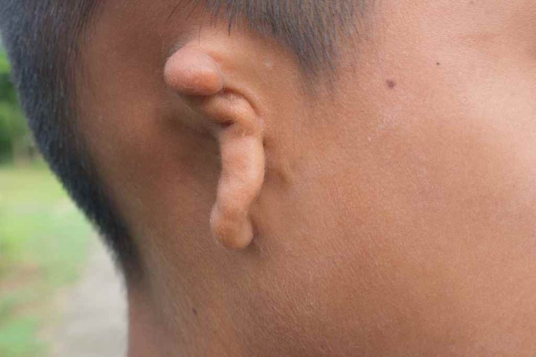 Hadirkan Solusi Kasus Microtia, Mahasiswa Unair Raih Pendanaan Riset Dikti