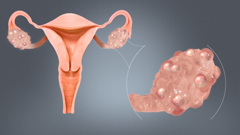 Yuk Kenalin Apa Itu Polycystic Ovary Syndrome