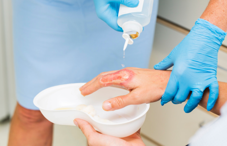 Anda Alami Trauma Luka Bakar? Guru Besar Ini Berikan Pilihan Terapinya